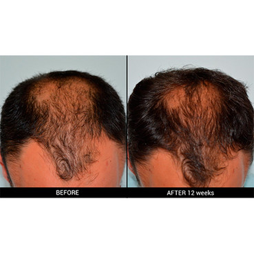 комплекс против реактивного выпадения волос rene furterer triphasic reactional anti-hair loss ritual (12*5ml) фото